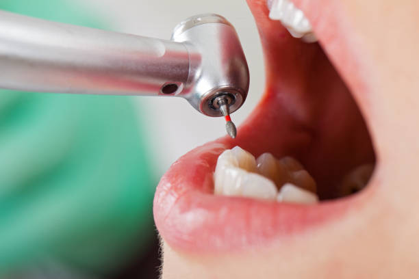 Best Chipped Tooth Repair Near Me  in Mount Pleasant, MI